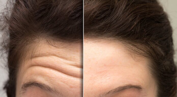Botox Forehead Before and After | See Real Results & Smoother Skin